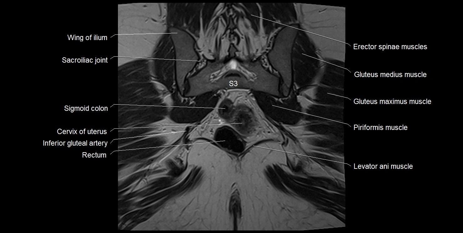 female pelvis coronal cross sectional anatomy image 29.webp